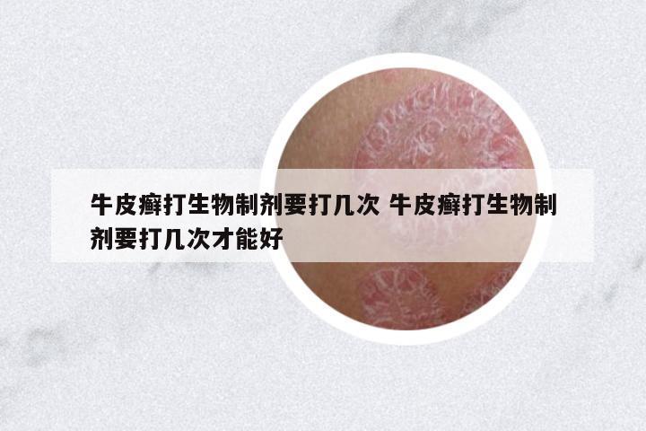 牛皮癬打生物制劑要打幾次 牛皮癬打生物制劑要打幾次才能好