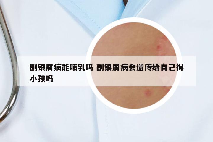副銀屑病能哺乳嗎 副銀屑病會(huì)遺傳給自己得小孩嗎