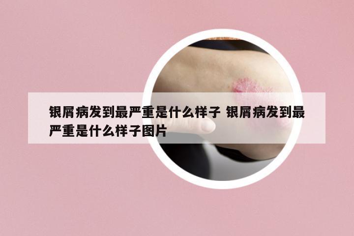 銀屑病發(fā)到最嚴(yán)重是什么樣子 銀屑病發(fā)到最嚴(yán)重是什么樣子圖片