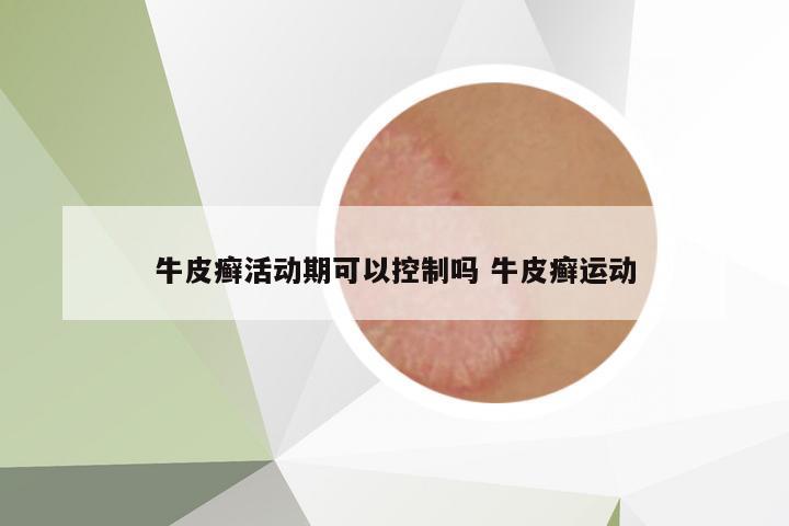 牛皮癬活動期可以控制嗎 牛皮癬運動
