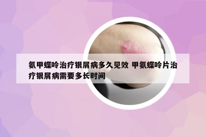 氨甲蝶呤治療銀屑病多久見效 甲氨蝶呤片治療銀屑病需要多長時間