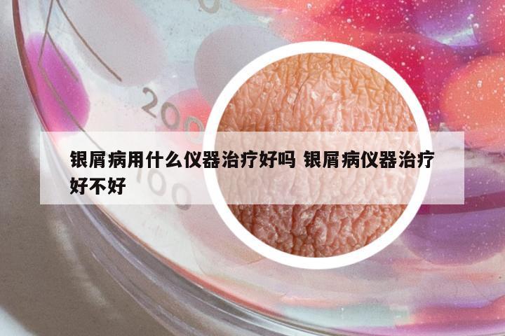 銀屑病用什么儀器治療好嗎 銀屑病儀器治療好不好