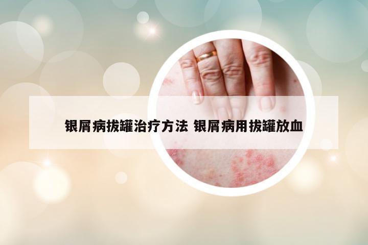 銀屑病拔罐治療方法 銀屑病用拔罐放血