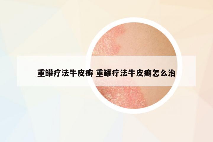 重罐療法牛皮癬 重罐療法牛皮癬怎么治