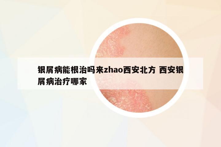 銀屑病能根治嗎來zhao西安北方 西安銀屑病治療哪家