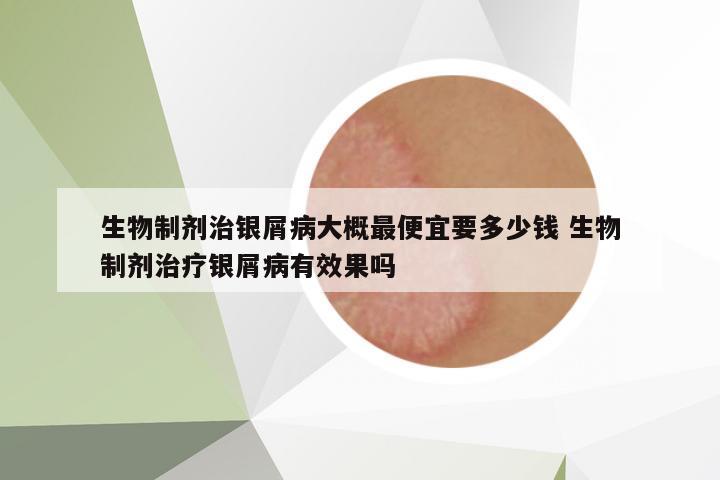 生物制劑治銀屑病大概最便宜要多少錢 生物制劑治療銀屑病有效果嗎