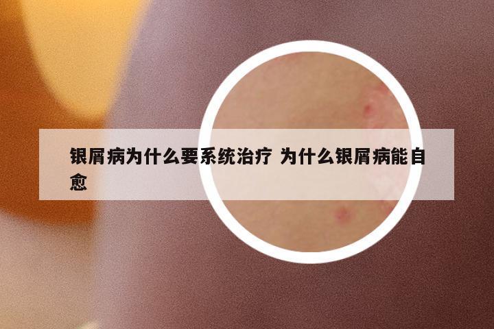 銀屑病為什么要系統(tǒng)治療 為什么銀屑病能自愈