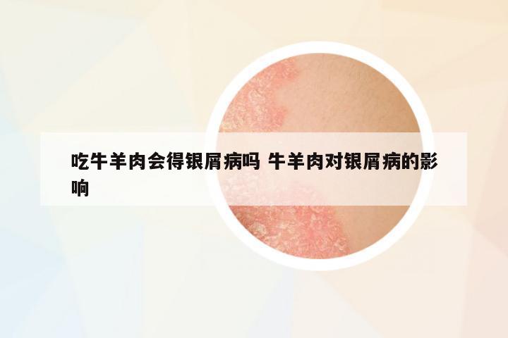 吃牛羊肉會得銀屑病嗎 牛羊肉對銀屑病的影響