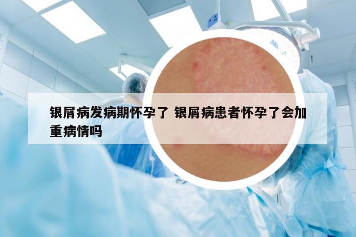 銀屑病發(fā)病期懷孕了 銀屑病患者懷孕了會(huì)加重病情嗎