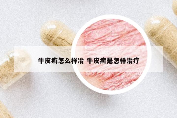 牛皮癬怎么樣冶 牛皮癬是怎樣治療