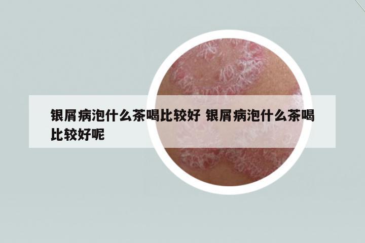 銀屑病泡什么茶喝比較好 銀屑病泡什么茶喝比較好呢