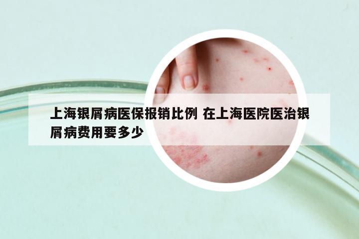 上海銀屑病醫(yī)保報銷比例 在上海醫(yī)院醫(yī)治銀屑病費用要多少
