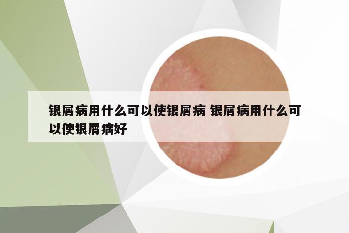 銀屑病用什么可以使銀屑病 銀屑病用什么可以使銀屑病好