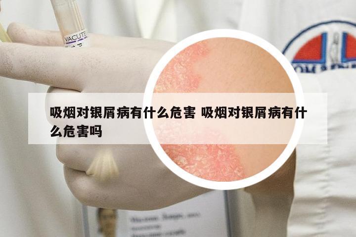 吸煙對銀屑病有什么危害 吸煙對銀屑病有什么危害嗎