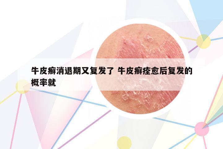牛皮癬消退期又復(fù)發(fā)了 牛皮癬痊愈后復(fù)發(fā)的概率就