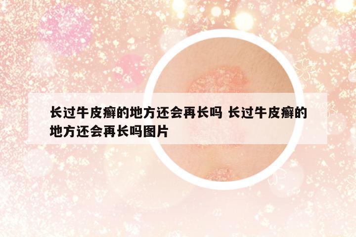 長過牛皮癬的地方還會(huì)再長嗎 長過牛皮癬的地方還會(huì)再長嗎圖片