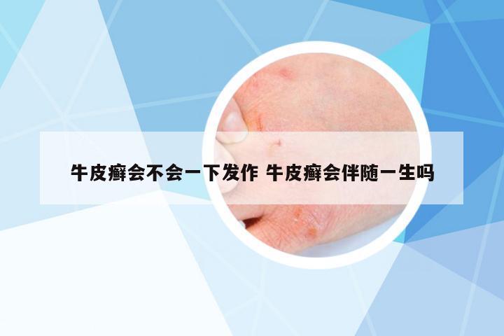 牛皮癬會(huì)不會(huì)一下發(fā)作 牛皮癬會(huì)伴隨一生嗎