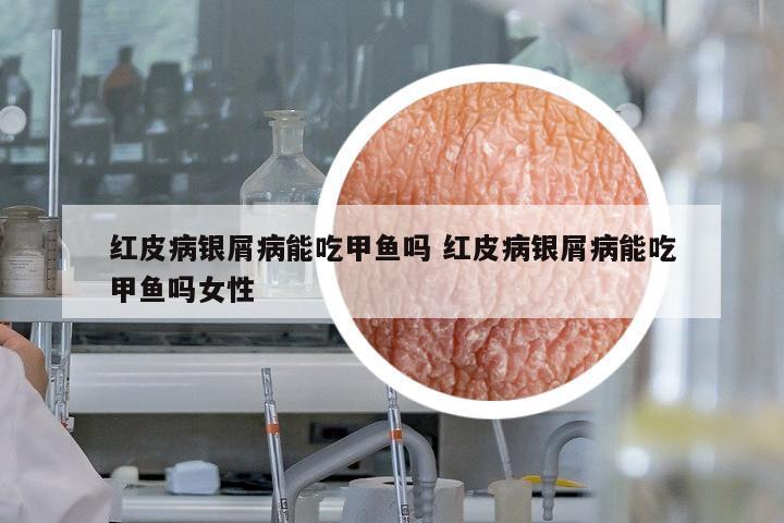 紅皮病銀屑病能吃甲魚(yú)嗎 紅皮病銀屑病能吃甲魚(yú)嗎女性