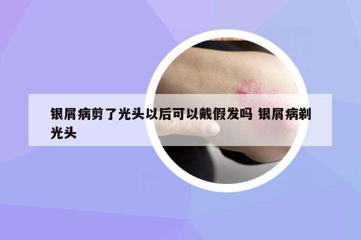 銀屑病剪了光頭以后可以戴假發(fā)嗎 銀屑病剃光頭