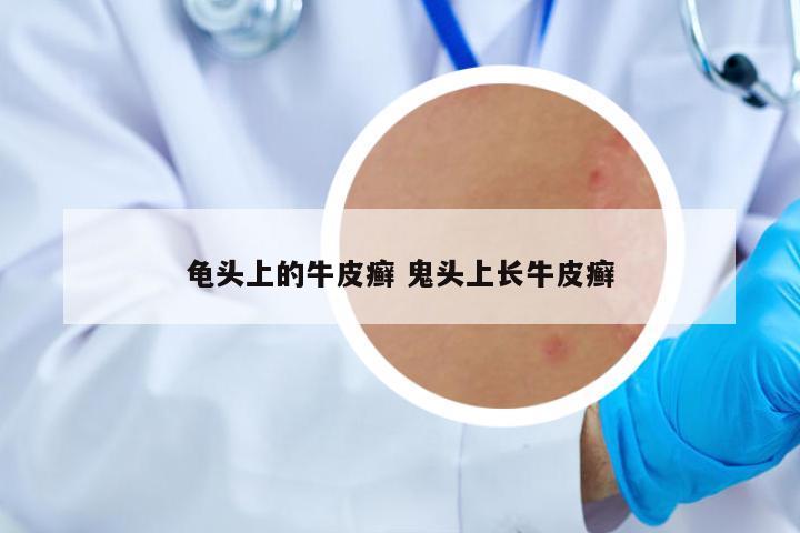 龜頭上的牛皮癬 鬼頭上長牛皮癬