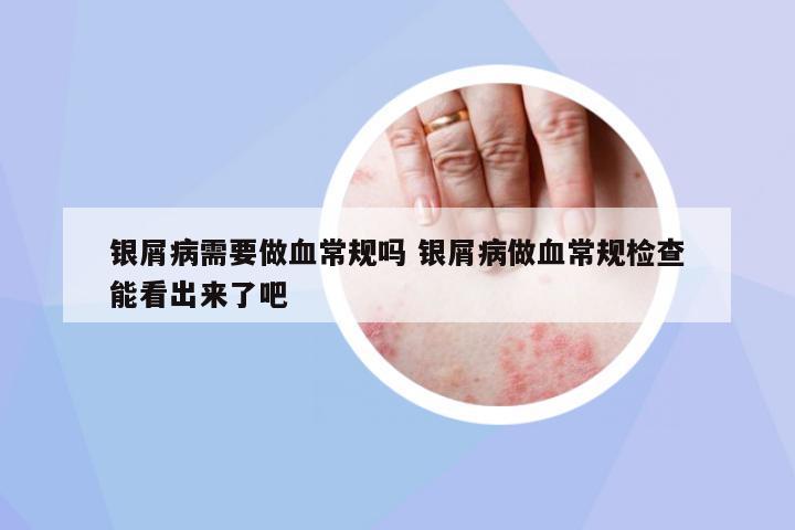 銀屑病需要做血常規(guī)嗎 銀屑病做血常規(guī)檢查能看出來了吧