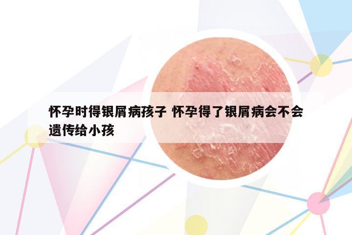 懷孕時得銀屑病孩子 懷孕得了銀屑病會不會遺傳給小孩