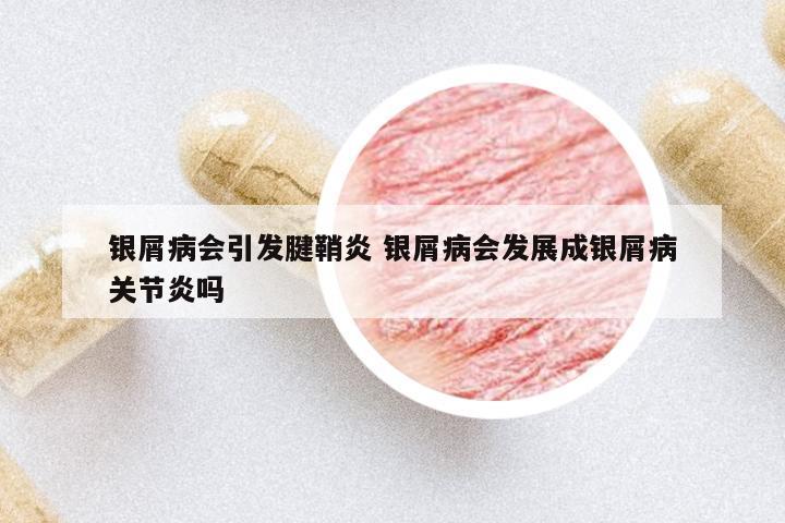 銀屑病會(huì)引發(fā)腱鞘炎 銀屑病會(huì)發(fā)展成銀屑病關(guān)節(jié)炎嗎