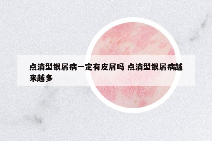 點滴型銀屑病一定有皮屑嗎 點滴型銀屑病越來越多