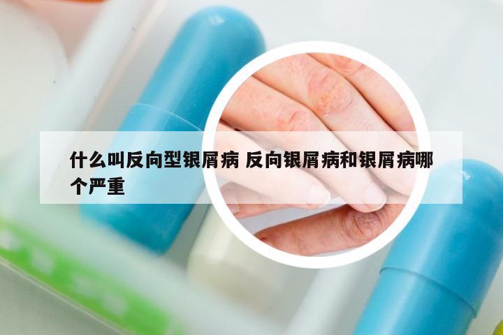 什么叫反向型銀屑病 反向銀屑病和銀屑病哪個(gè)嚴(yán)重
