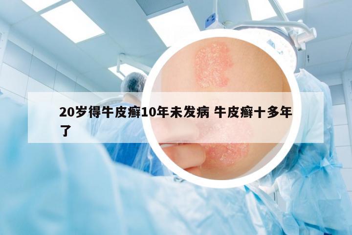 20歲得牛皮癬10年未發(fā)病 牛皮癬十多年了