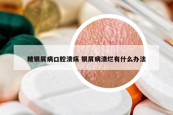 糖銀屑病口腔潰瘍 銀屑病潰爛有什么辦法