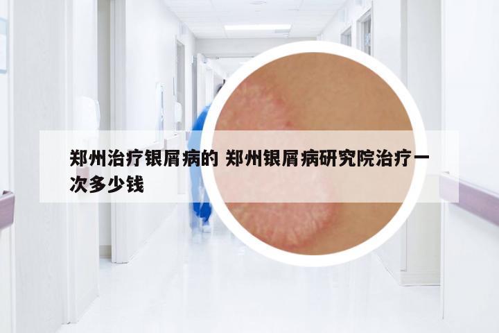 鄭州治療銀屑病的 鄭州銀屑病研究院治療一次多少錢