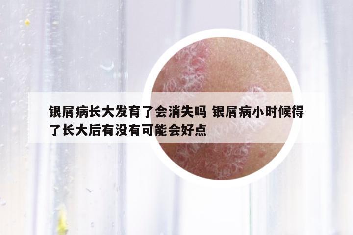 銀屑病長大發(fā)育了會消失嗎 銀屑病小時候得了長大后有沒有可能會好點