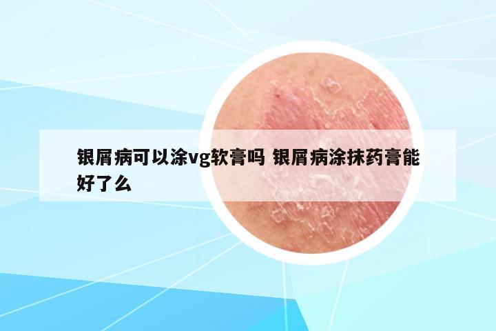 銀屑病可以涂vg軟膏嗎 銀屑病涂抹藥膏能好了么