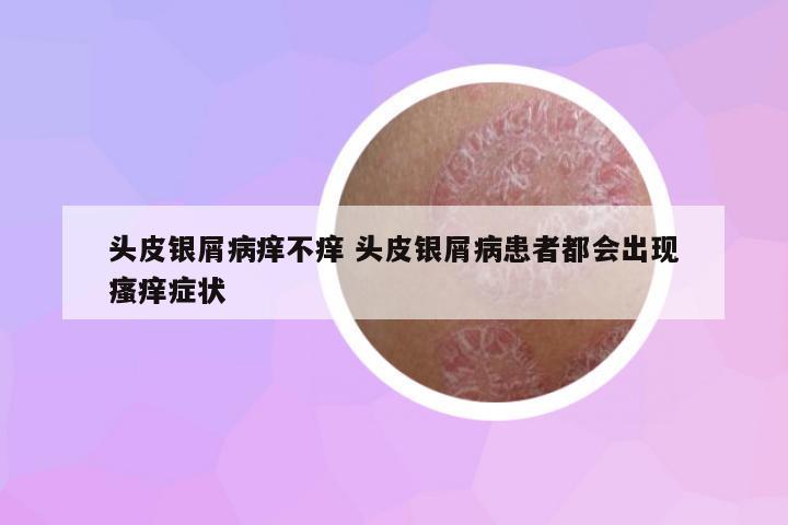 頭皮銀屑病癢不癢 頭皮銀屑病患者都會出現瘙癢癥狀