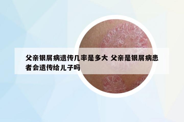 父親銀屑病遺傳幾率是多大 父親是銀屑病患者會(huì)遺傳給兒子嗎