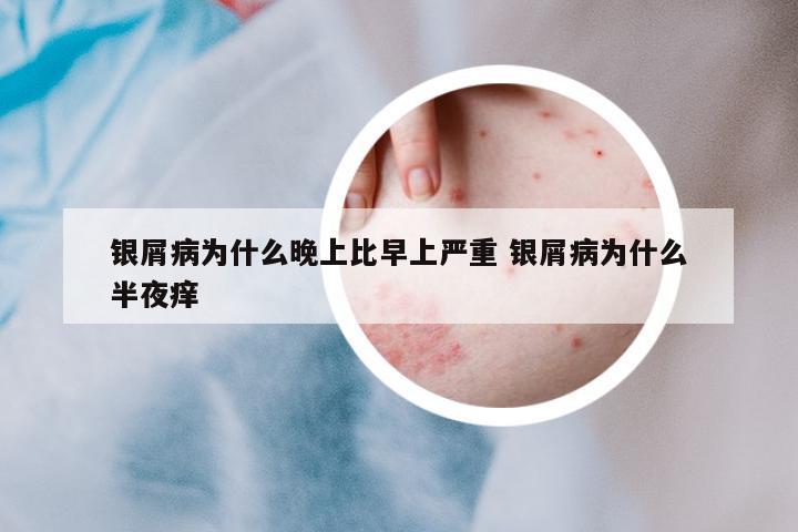 銀屑病為什么晚上比早上嚴重 銀屑病為什么半夜癢