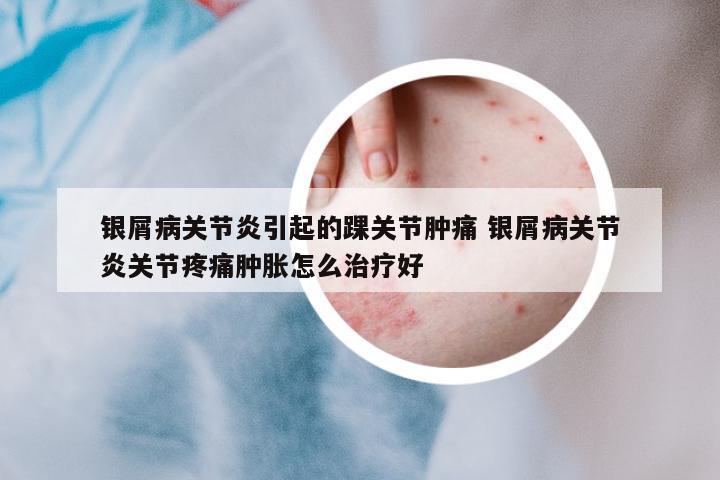 銀屑病關(guān)節(jié)炎引起的踝關(guān)節(jié)腫痛 銀屑病關(guān)節(jié)炎關(guān)節(jié)疼痛腫脹怎么治療好