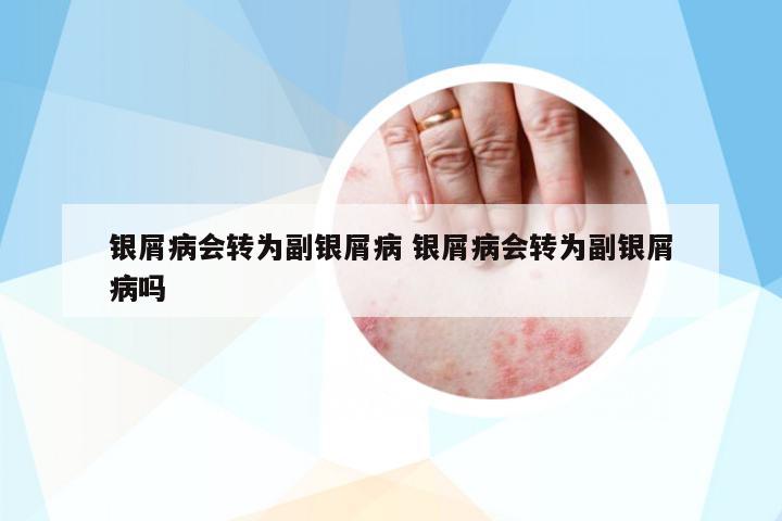 銀屑病會(huì)轉(zhuǎn)為副銀屑病 銀屑病會(huì)轉(zhuǎn)為副銀屑病嗎