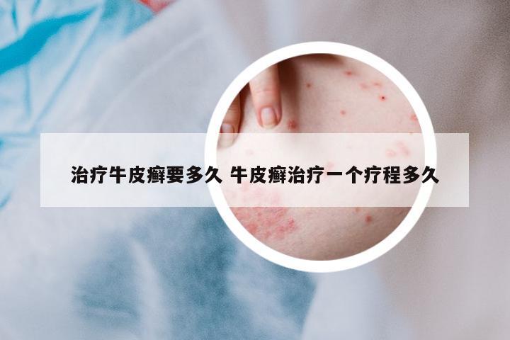 治療牛皮癬要多久 牛皮癬治療一個療程多久