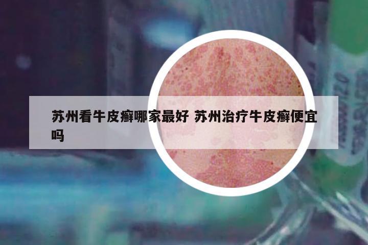 蘇州看牛皮癬哪家最好 蘇州治療牛皮癬便宜嗎