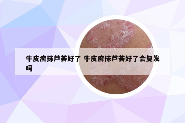 牛皮癬抹蘆薈好了 牛皮癬抹蘆薈好了會(huì)復(fù)發(fā)嗎
