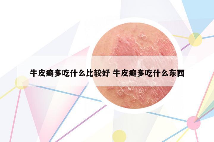 牛皮癬多吃什么比較好 牛皮癬多吃什么東西