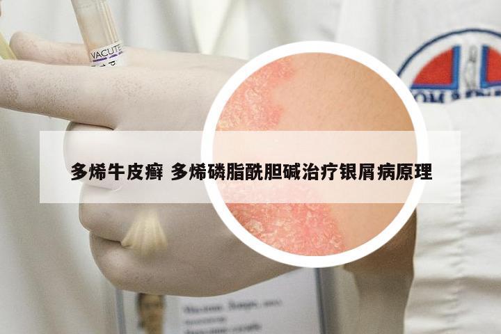 多烯牛皮癬 多烯磷脂酰膽堿治療銀屑病原理