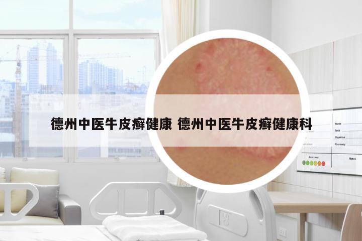 德州中醫(yī)牛皮癬健康 德州中醫(yī)牛皮癬健康科