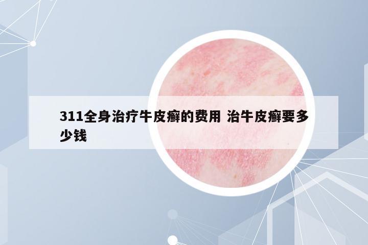 311全身治療牛皮癬的費用 治牛皮癬要多少錢