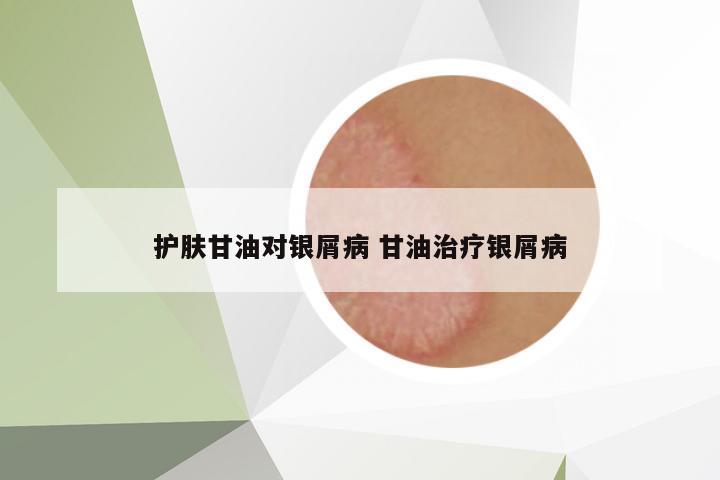 護(hù)膚甘油對(duì)銀屑病 甘油治療銀屑病