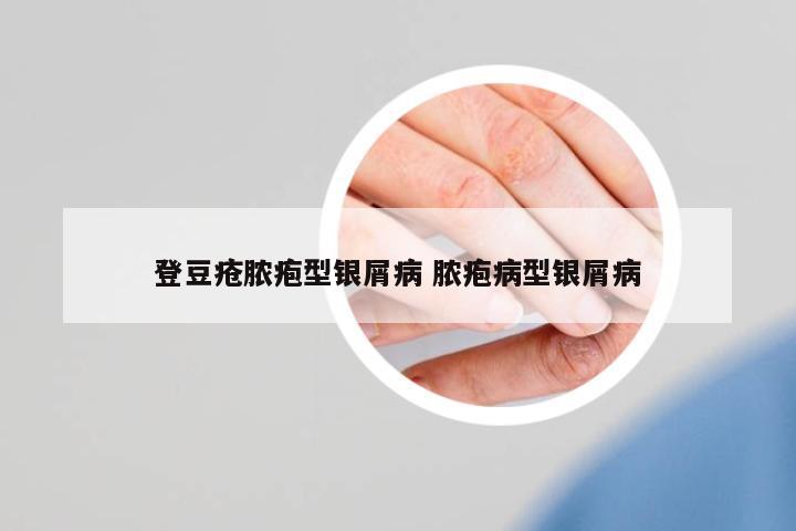 登豆瘡膿皰型銀屑病 膿皰病型銀屑病