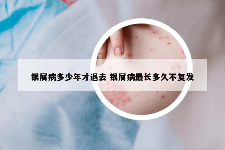 銀屑病多少年才退去 銀屑病最長多久不復發(fā)