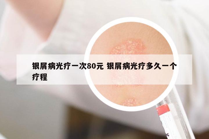 銀屑病光療一次80元 銀屑病光療多久一個(gè)療程